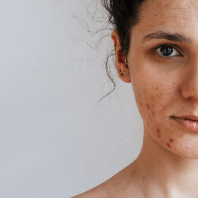 huidproblemen, droge huid, huidschilfers, acne, pukkels